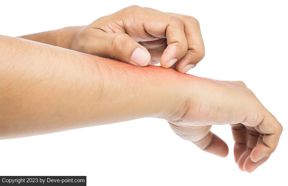 6 Tips For Living With Eczema